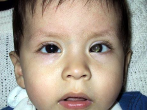 Çocuklarda Retinoblastom (Göz Kanseri) için Selektif Oftalmik Kemoterapi