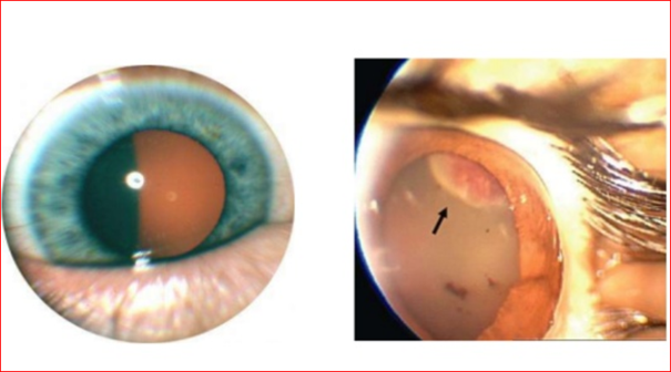 Göz İçi Tümörlerin Belirtileri Nelerdir