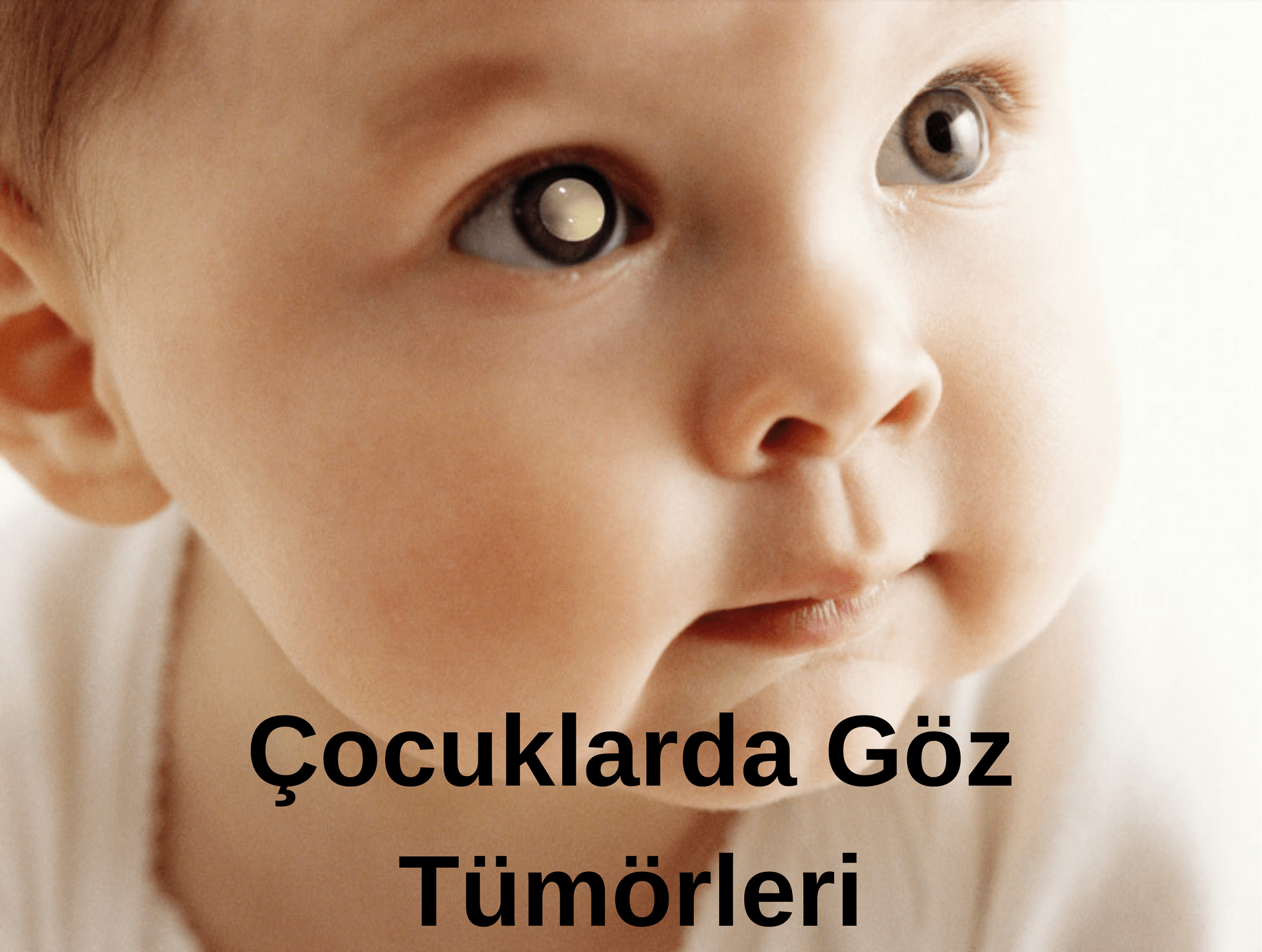Retinoblastom Çocuklarda Göz Tümörleri