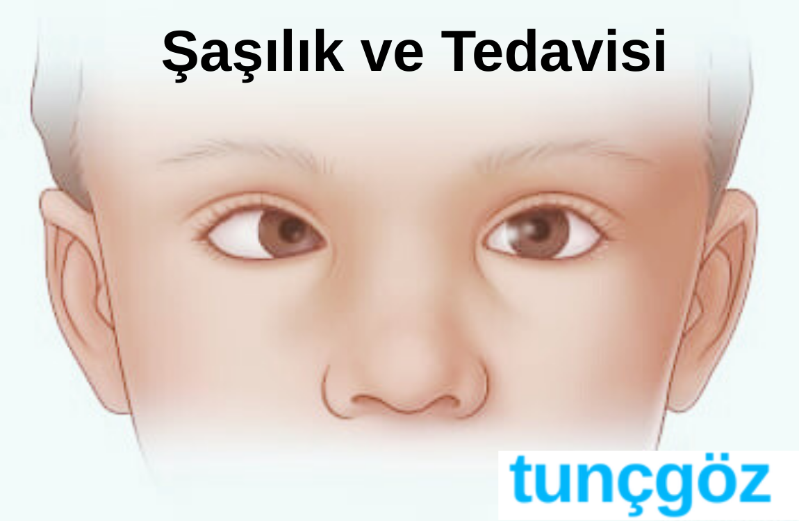 şaşılık ve tedavisi